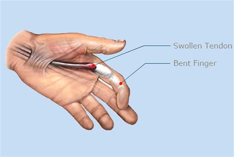 Hand Wrist Conditions Diagnoses Treatment Soflo Hand Center