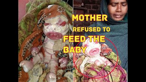 5 Bizarre Horrible Birth Defects Parents Refused To Feed Youtube