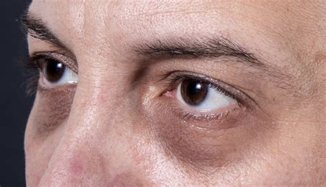 Under Eye Filler The Best Treatments For Under Eye Bags Dark Circles