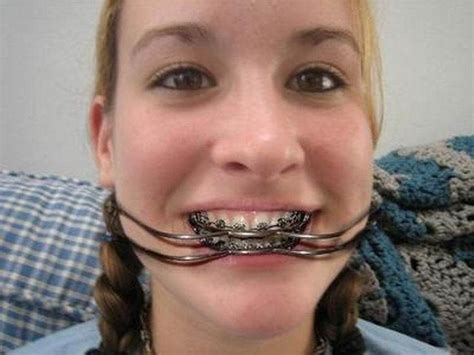 Image Result For Milwaukee Brace Pictures Braces Girls