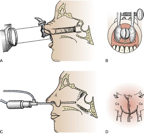 Endoscopic Endonasal Pituitary And Skull Base Surgery Neupsy Key