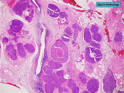 Qiaos Pathology Pleomorphic Lobular Carcinoma In Situ P Flickr