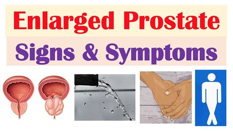 Enlarged Prostate Signs Symptoms Why They Occur Youtube