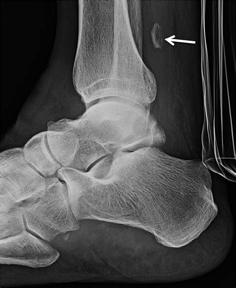 Lateral Radiograph Of The Right Foot Following Trauma X Ray Shows The My Xxx Hot Girl