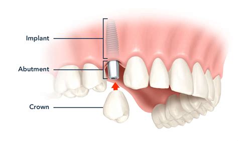 Dental Implants Diagram Bpi Dental