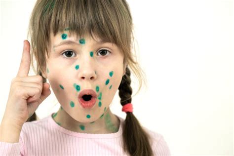 70 Smallpox Rashes On Childrenฃ Stock Photos Pictures And Royalty Free
