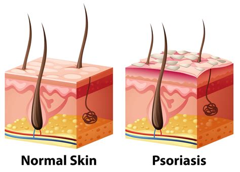 Top 4 Dermatologist Recommended Treatments For Psoriasis Sba Dermatology