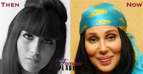 Cher Before And After Lip Augmentation Show Shifting Lip Implants