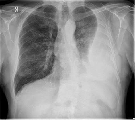 If one of the following is present the fluid is virtually always an exudate. Malignant Pleural Effusion - Pulmonology Advisor