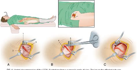 Figure 1 From Dynamic Decompression Of The Lateral Femoral Cutaneous