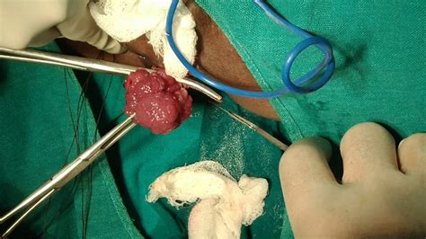 S javed ali p.g scholar national institute of unani medicine (nium) bangalore 91, india. Excision of Rectal polyp By Dr.Firdose Ahmad , NIUM ...