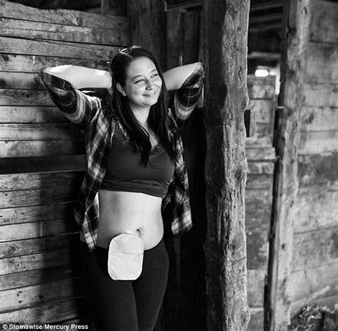 12 Brave People Show Off Their Stoma Bags For 2017 Ostomy Awareness Calendar Daily Mail Online