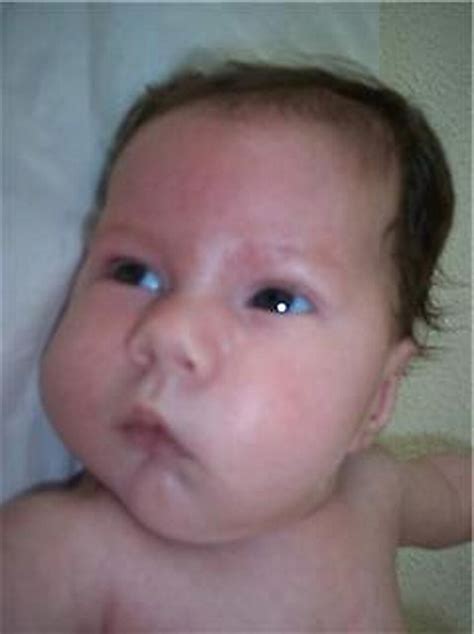 A Newborn With Hypotonia And Abnormal Facies The Bmj