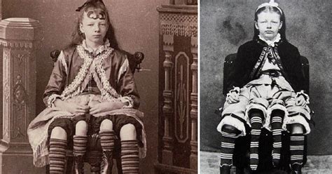 Rather than having a parasitic twin, myrtle's extra legs resulted from an even rarer form of conjoined twinning. Myrtle Corbin Was A Four Legged Woman Who Had Five Kids Of Her Own