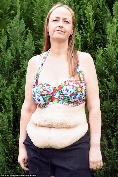 Overweight Mother Says She Now Has An Old Lady Body With Saggy Excess