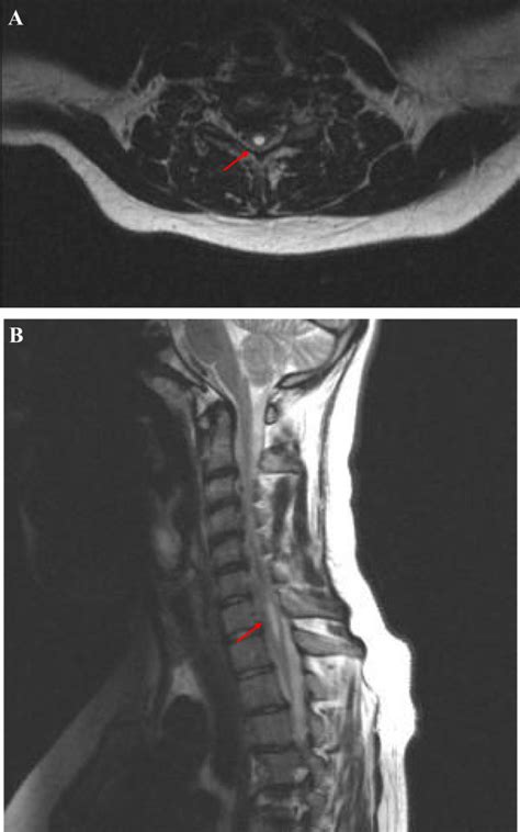 Mri Of The Spine A Axial T2 Weighed Mri Of The Cervical Spine Showing