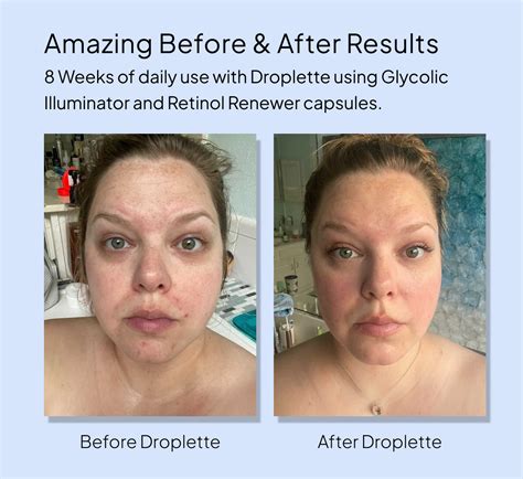 Benefits Of Using Glycolic Acid And Retinol Droplette