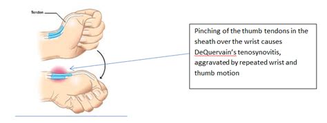 Dequervains Tenosynovitis Hand Surgery Associates