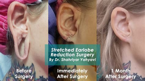 Stretched Earlobe Reduction Surgery By Dr Shahriyar Yahyavi Youtube