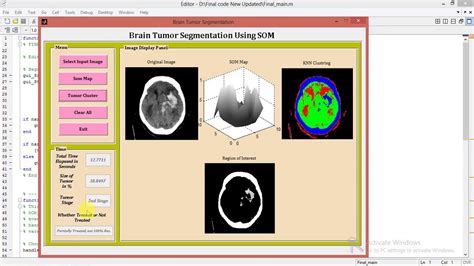Matlab Project For Brain Tumor Detection Using Watershed Segmentation
