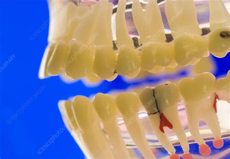 Tooth Decay Dental Model Stock Image M7820240 Science Photo Library