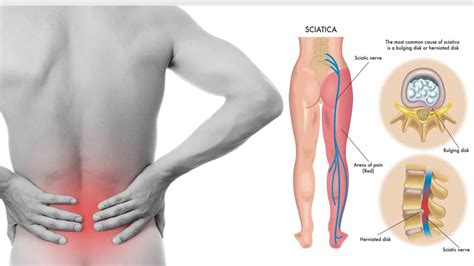 Lower left back pain is more common compared to the back pain felt in the lower right quadrant. 8 Sciatica Stretches to Help Prevent and Relieve Hip and ...