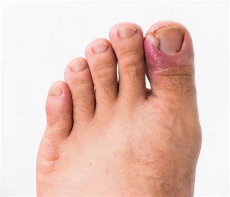 Ingrown Toenail Pain Relief Treatment And Prevention Masterton Foot Clinic