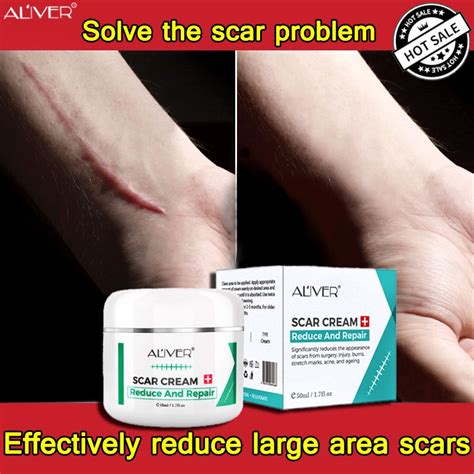 Aliver Scar Removal Cream 50ml Treatment Acne Control Acne Scar Remover