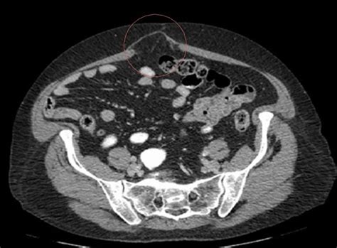 Ct Scan Of A Patient With An Umbilical Hernia Download Scientific Diagram