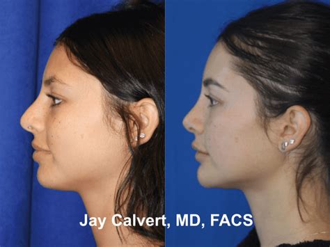 Rhinoplasty Before And After Beverly Hills Dr Jay Calvert