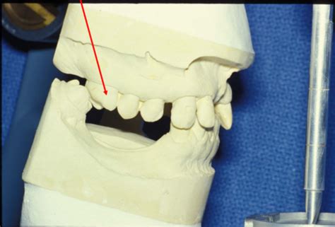 Alignment And Occlusion Of The Dentition Flashcards Quizlet