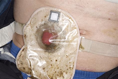 Ileostomy In Rectal Cancer Stock Image C Science Photo Library