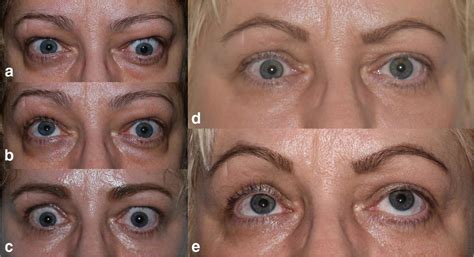 Case 3 Preoperative Aspect Of A Graves Ophthalmopathy Patient In