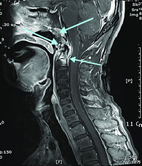 Magnetic Resonance Imaging Of The Patients Cervical Spine