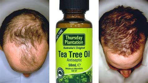 How To Use Tea Tree Oil For Fast Hair Growth Youtube