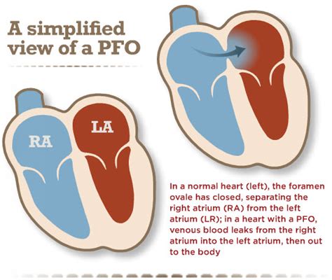 Patent Foramen Ovale Pfo American Heart Association