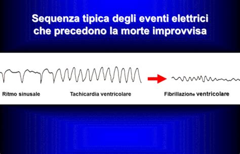 In afib il problema è con le camere superiori del cuore, o atri. *Chi è a rischio di morte improvvisa - gennarino borrello