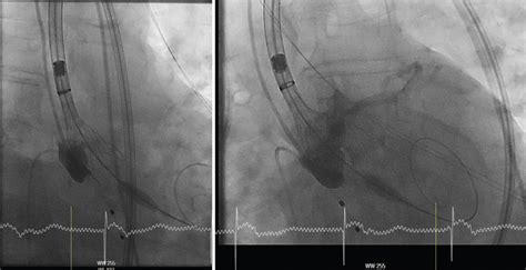 Implantation Of A Self Expandable Evolut Pro Using The Cusp Overlap