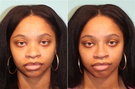 Non Surgical Rhinoplasty Photos Chevy Chase Md Patient 22446