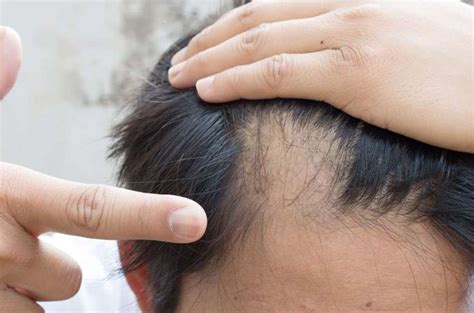Tips for thin hair from experts. How to Stop, Regrown and Prevent a Receding Hairline ...