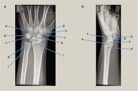 Radiological Imaging Of The Wrist Joint Orthopaedics And Trauma