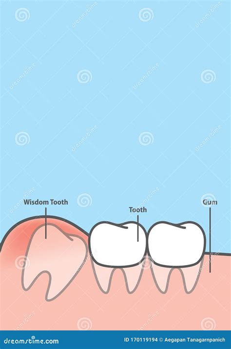 Blank Banner Wisdom Impacted Tooth Inside Under Inflammation Gum