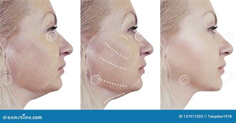 Woman Double Chin Before And After Procedures Collage Stock Image