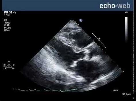 Echo-Web - Severe Aortic Stenosis with Mitral Involvement - YouTube