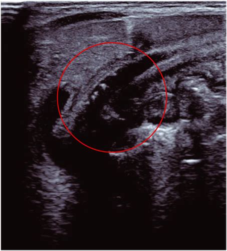 Ultrasound‐guided Positioning Of Transpyloric Feeding Tubes In