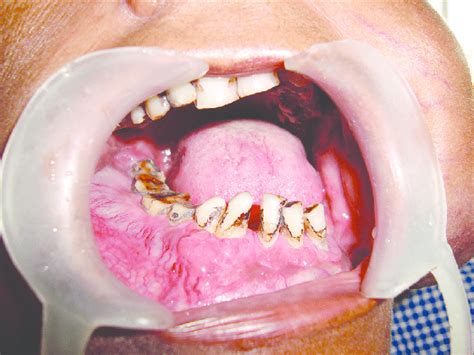 Intraoral Examination Shows Diffuse Swelling Obliterating The