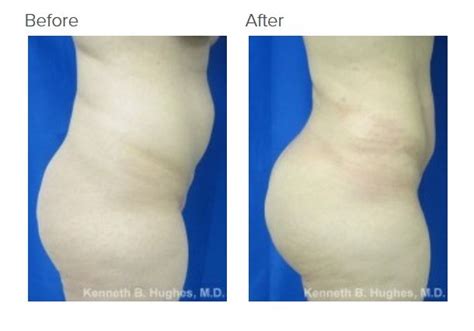 Pin On Best Liposuction And Brazilian Buttlift Bbl With Dr Kenneth