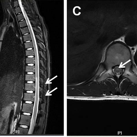 A B The Sagittal Magnetic Resonance Imaging Of The Spinal Cord In A