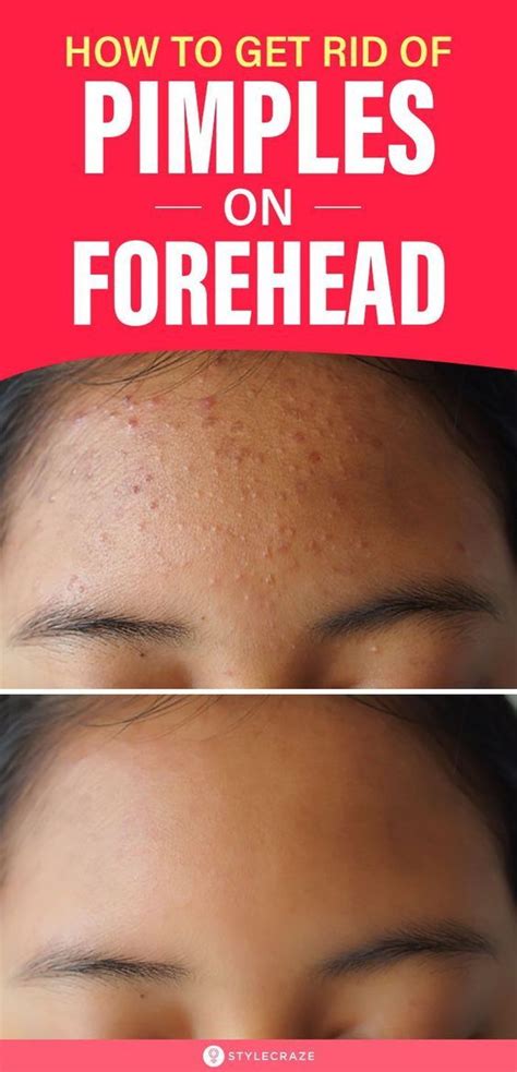 Forehead Acne Causes Treatment And Prevention Tips In 2022 Pimples