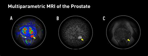 Multiparametric Mriultrasound Fusion Biopsy Improves Prostate Cancer